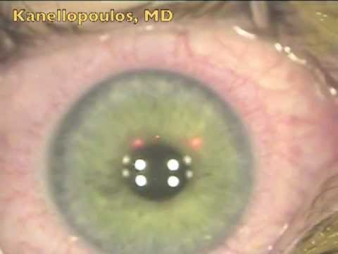 The introduction of CXL combined with routine LASIK, Kanellopoulos, MD (LASIK Xtra) 2012