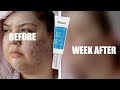 TESTING MURAD OUTSMART BLEMISH/ACNE TREATMENT FOR A WEEK: OILY/ACNE PRONE SKIN