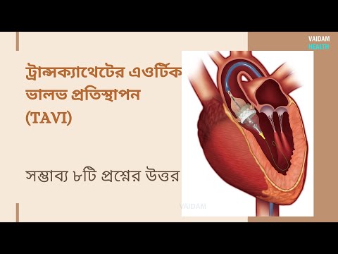 TAVI- ৮ টি প্রায়শই জিজ্ঞাসিত প্রশ্ন