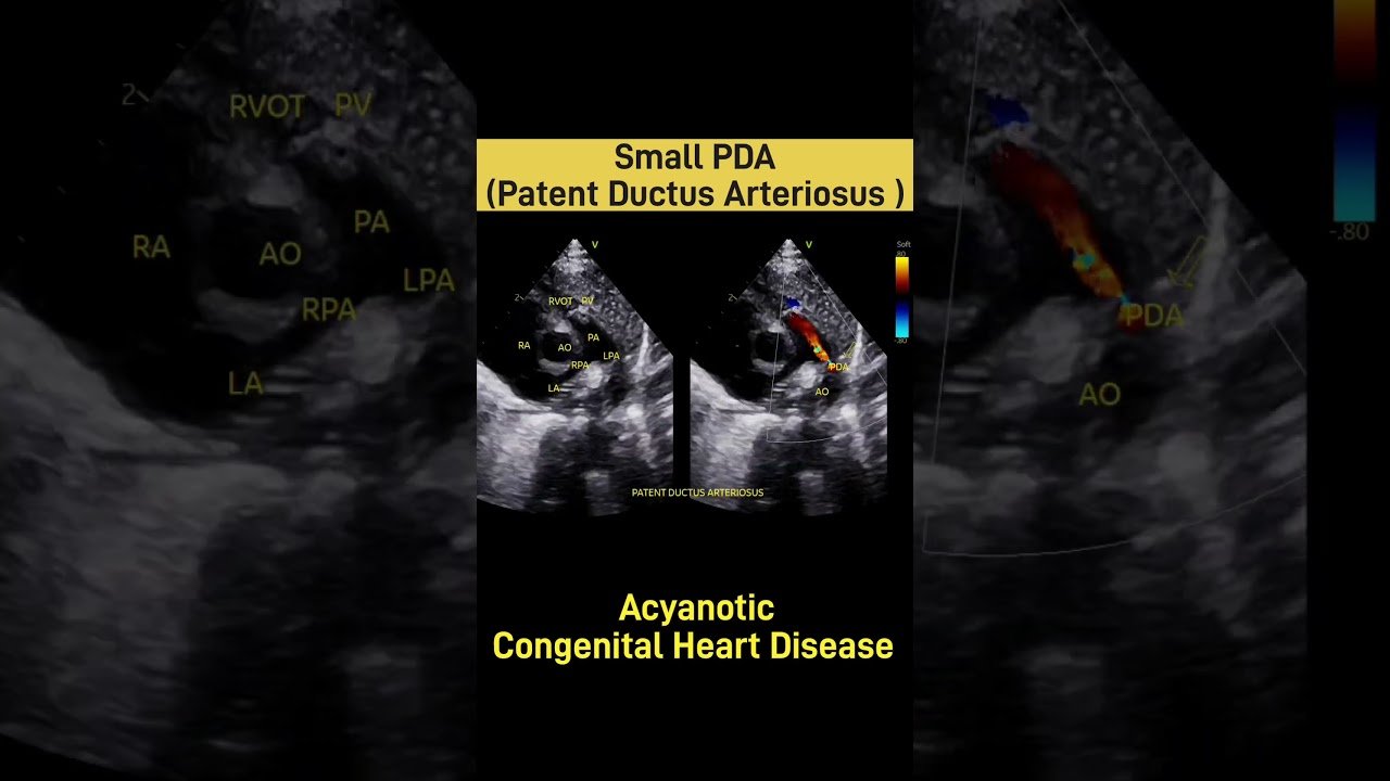 Small Patent Ductus Arteriosus (PDA) on 2D Echo | EchoDx Hub