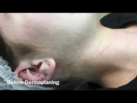 Dermaplaning