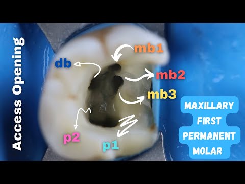 Jak łatwo odnaleźć kanały policzkowe mezjalne? | Dostęp endodontyczny w pierwszym trzonowcu szczęki