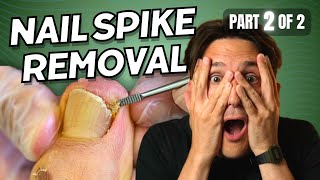 Download lagu Ingrown Toenail Spike Removal part 2 of 2 mp3