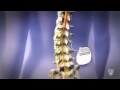 Spine Stimulator for Pain
