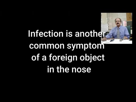 Foreign Body Nose Removal | Nasal Foreign Body Removal Techniques | Sultan Badar Munir