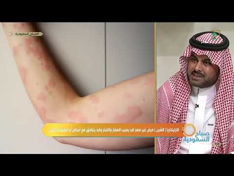 , title : '#صباح_السعودية | حساسية الارتيكاريا يتحدث عنها د. ياسر مليباري أخصائي بطب وجراحة الأمراض الجلدية'