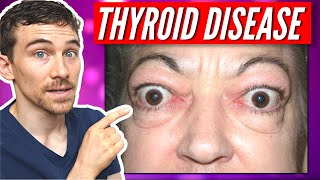 7 Signs of Thyroid Eye Disease and Graves Disease