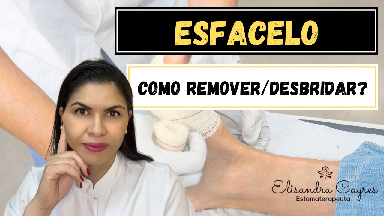 ESFACELO COMO REMOVER/DESBRIDAR?