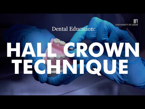 Dental Hall Crown Placement Technique