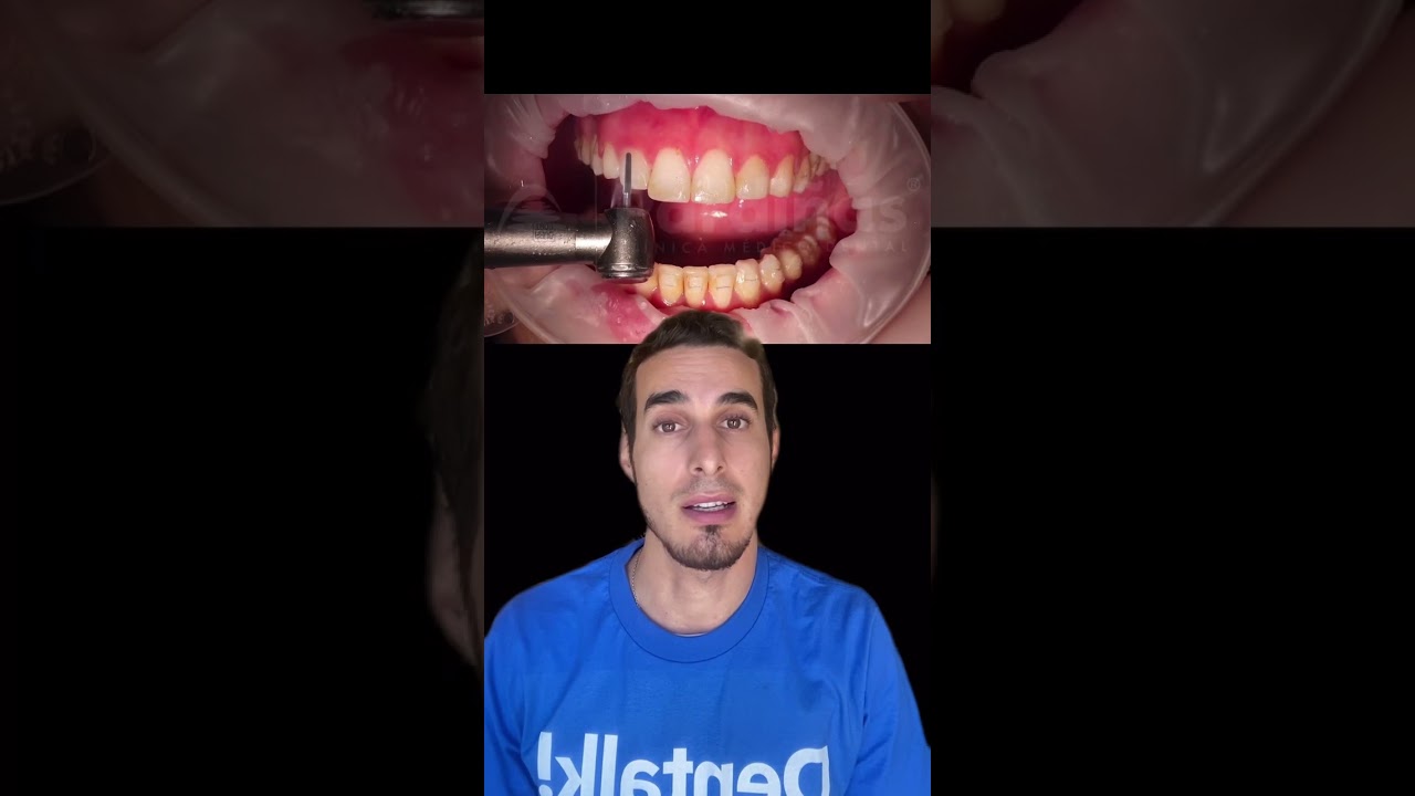 Retiro de BRACKETS paso a paso - Cómo se quita la Ortodoncia