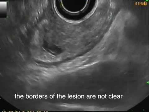 EUS Staging of an Esophageal Adenocarcinoma