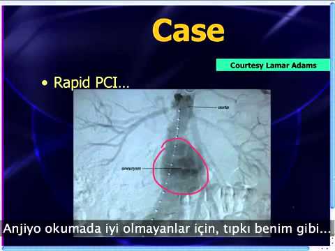 Mattu EKG Vakası - QR-T İşareti ve STEMI - 10 Haz 2013  (Türkçe Altyazılı)