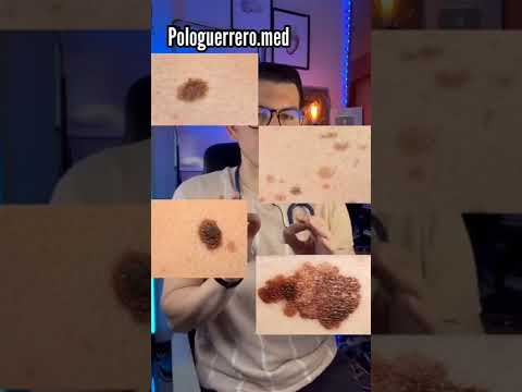 ¿Cómo saber si un lunar es normal o no? #medicina #shorts #sabiasque