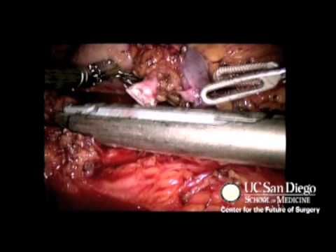 Robotic Technique For Challenging Aspects Of Donor Nephrectomy