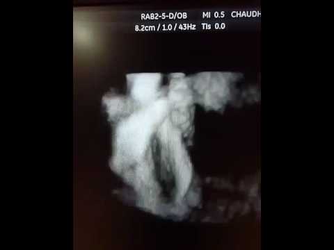 4D stic showing pulmonary stenosis in fetal cardiac echocardiography