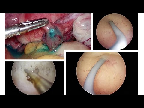 Fundamentos e instrumentos de histeroscopia del Dr. Modi