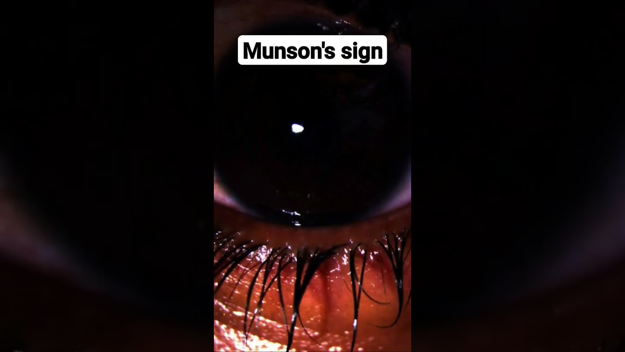 Munson's sign