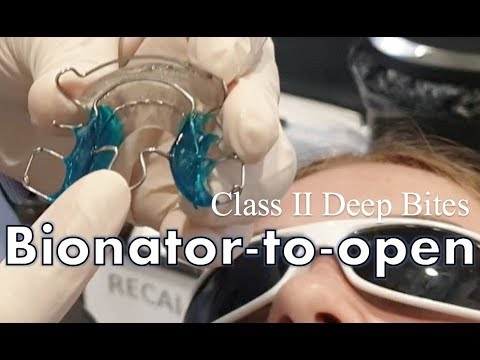 Bionator Retainer PART 2 - Opening Deep Bites