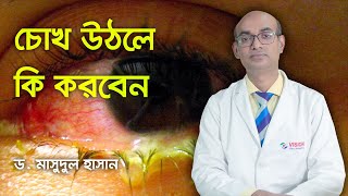 চোখ ওঠার কারণ ও প্রতিকার | CONJUNCTIVITIS || Dr. Md. Masudul Hasan | Cornea Specialist & Surgeon ||
