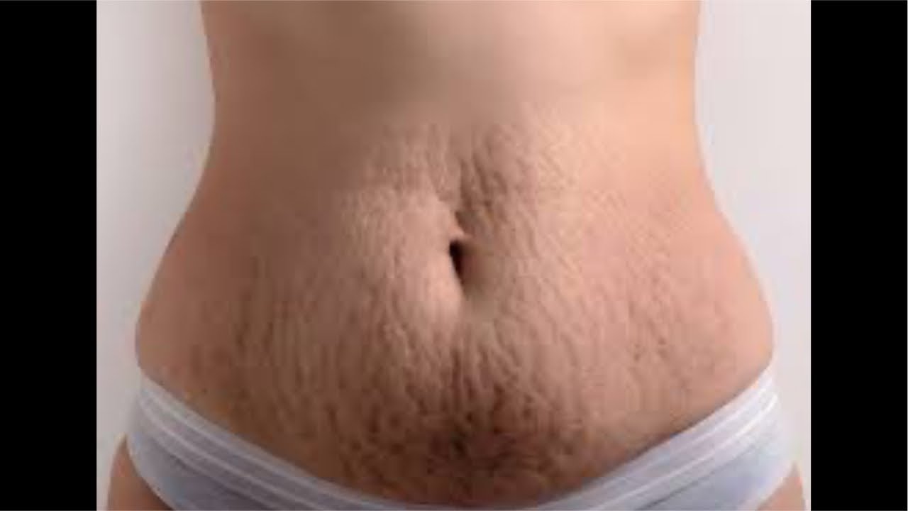 COMO ELIMINAR ESTRIAS |Dr Dayan Siebra