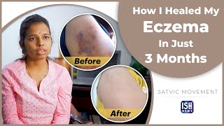 How I Healed My Eczema In Just 3 Months