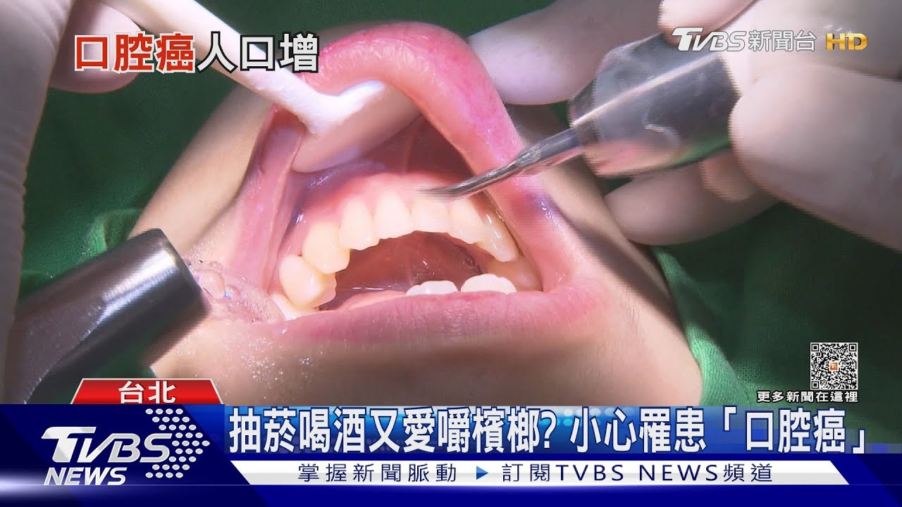 戒菸酒戒檳榔! 檢視口腔癌還要注意「這幾點」