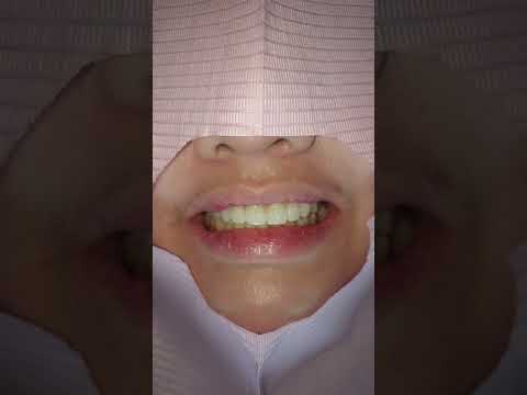 Zirconia Fixed Bridge