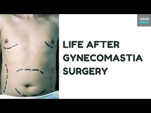 Life after Gynecomastia Surgery