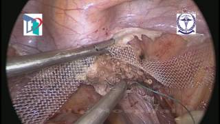 Laparoscopic Pectopexy Vs Sacropexy along with TLH in 3rd Degree UV Prolapse