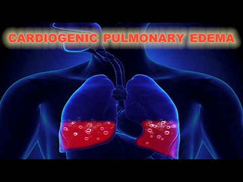 Cardiogenic Pulmonary Edema - CRASH! Medical Review Series