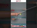 Penis का खतना करवाना चाहिए Stapler Circumcision Bloodless Painless