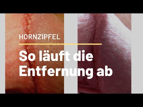 How does a penis skin tag removal work?