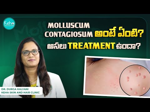 Molluscum Contagiosum Treatment in telugu || Molluscum Contagiosum Cream, Virus, and Symptoms || ...