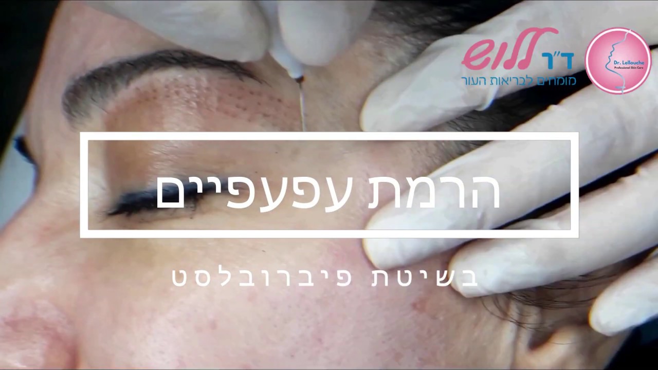 מתיחה והרמת עפעפיים – בשיטה המהפכנית פיברובלסט פלזמה !