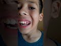 Olliver Arrancou Dente Na Unha