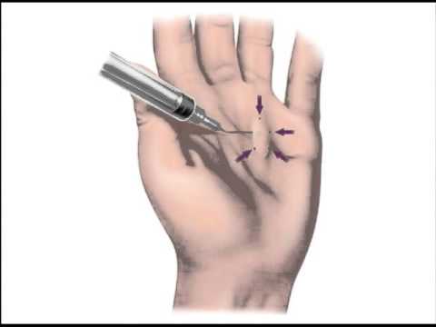 Non-Surgical Treatment of Dupuytren's Contracture: Brian Fingado, MD, Orthopedic Hand Specialist