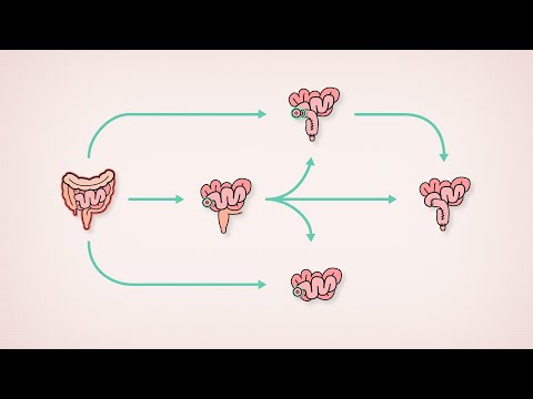 Surgical treatment for Ulcerative Colitis | Patient Education | TVASurg