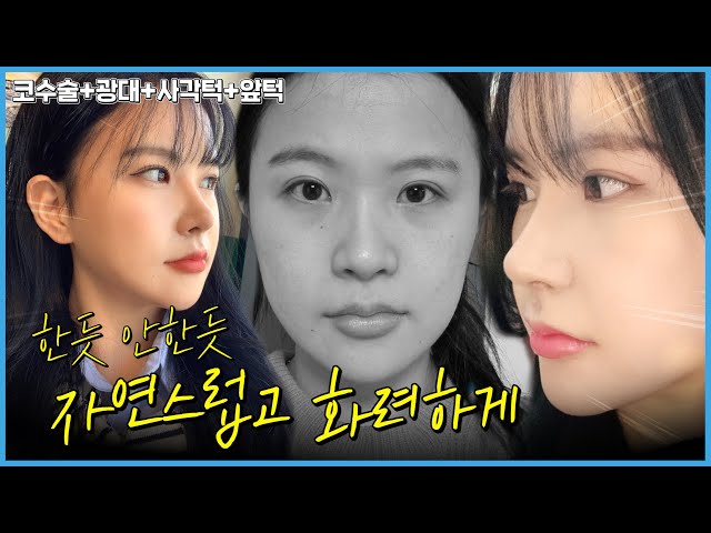 더 예쁘게, 에이비성형외과 이벤트 더 예쁘게, 에이비성형외과 이벤트
