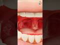 Tonsil Removal Surgery 3D Medical Animation Tonsil Tonsillectomy Surgery Shorts