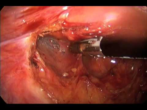 Laparoscopic Resection of RectoSigmoid in Treating Carcinoma with Diverting Ileostomy