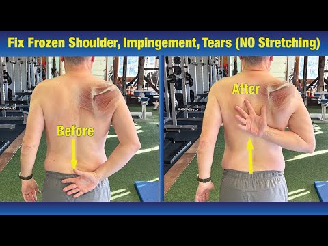 INCREDIBLE way to Fix Frozen Shoulder & Impingement - (NO Stretching or PT Exercises)