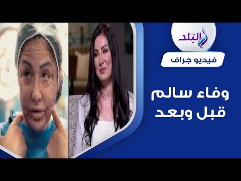 لن تصدق شكلها قبل وبعد أول ظهور للفنانة وفاء سالم بعد تصحيح تشوهات وجهها