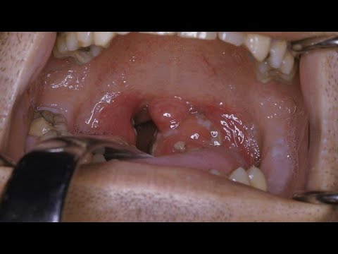 comment se soulager  des arrêts du poisson  dans  la GORGE  ?#astuce #tuto #santé  #poisson