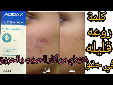 علاج آثار الحبوب والحروق والجروح غيهنيك من بقع الداكنهaddax#