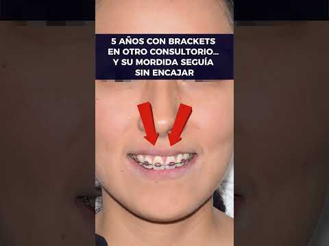 Video de un caso de retratamiento de ortodoncia