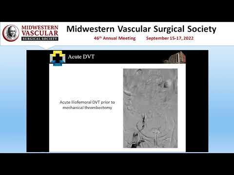Initial Outcomes in Iliofemoral Stenting in Acute vs Chronic DVT