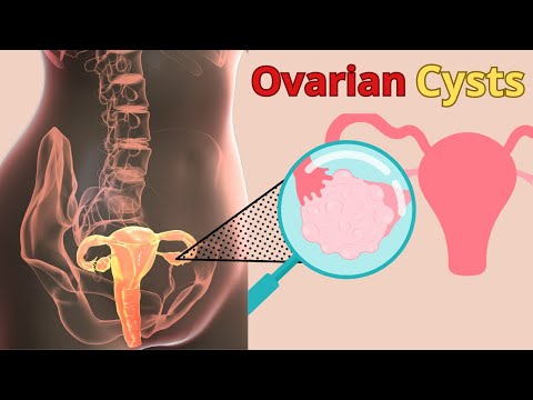 Ovarian cysts: causes, symptoms, types and treatment.