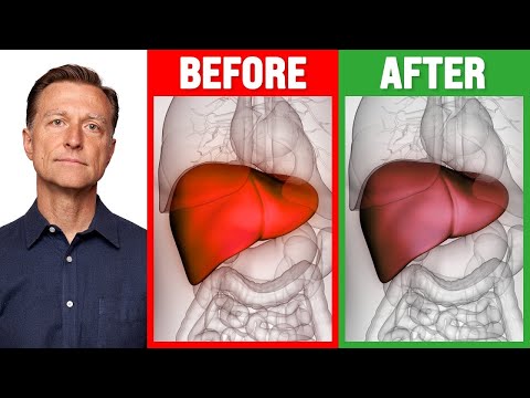 How Your Feet Are Warning You About Your Liver Problems Dr Berg Explains