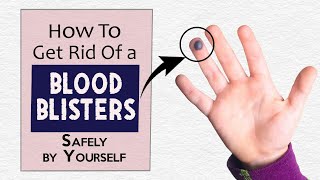 How to Get Rid of a Blood Blister Safely by Yourself