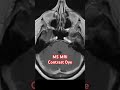 MS MRI Contrast Dye
